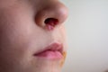 Herpes on the nose - Pretty young caucasian boy with herpes her on nose. Close-up. Human Virus