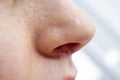 Herpes on the nose - Pretty caucasian woman with herpes her on nose, close-up. Human Virus Royalty Free Stock Photo