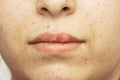 Herpes oral cold sore blisters on the lips- herpes simplex