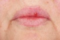 Herpes oral cold sore blisters on the woman lips, herpes simplex