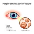 Herpes simplex eye infections. A red human`s eye Royalty Free Stock Photo