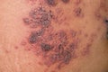 Herpes simplex infection at abdomen. Small and painful vesicles Royalty Free Stock Photo