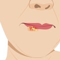 Herpes simplex virus or HSV on the lip close-up illustration Royalty Free Stock Photo