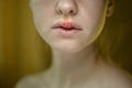 Herpes Simplex Virus on the Upper Lip of a Young Beautiful Woman. Royalty Free Stock Photo