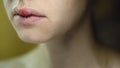 Herpes Simplex Virus on the Upper Lip of a Young Beautiful Woman. Royalty Free Stock Photo