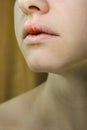 Herpes Simplex Virus on the Upper Lip of a Young Beautiful Woman. Royalty Free Stock Photo