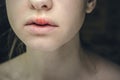 Herpes Simplex Virus on the Upper Lip of a Young Beautiful Woman. Royalty Free Stock Photo