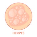 Herpes on the skin. Healthcare and dermatology