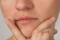 Herpes sore with pus on the lips of the young beautiful girl and Royalty Free Stock Photo