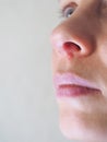 Herpes under the nose. Close up