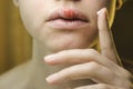 Beautiful Woman Applying Ointment on Her Upper Lip with Herpes. Royalty Free Stock Photo