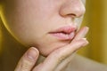 Beautiful Woman Applying Ointment on Her Upper Lip with Herpes. Royalty Free Stock Photo