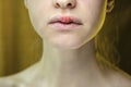 Herpes Simplex Virus on the Upper Lip of a Young Beautiful Woman. Royalty Free Stock Photo