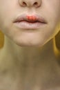 Herpes Simplex Virus on the Upper Lip of a Young Beautiful Woman. Royalty Free Stock Photo