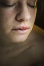 Herpes Simplex Virus on the Upper Lip of a Young Beautiful Woman. Royalty Free Stock Photo