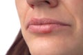 Herpes virus. Herpes disease on the lips of a 30 year old woman. Infectious virus. Close-up of the manifestation of herpes on the