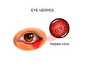 The herpes virus of the eye Royalty Free Stock Photo