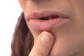 Herpes virus. Herpes disease on the lips of a 30 year old woman. Infectious virus. Close-up of the manifestation of herpes on the Royalty Free Stock Photo