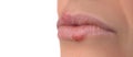 Herpes virus. Herpes disease on the lips of a 30 year old woman. Infectious virus. Close-up of the manifestation of herpes on the Royalty Free Stock Photo