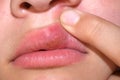 Herpes virus on the lip Royalty Free Stock Photo