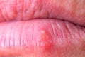 Herpes virus on the lower lip of an adult male close-up