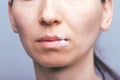 The Herpes virus on mouth of young woman