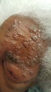 Herpes zoster of left V1 dermatomal skin - uncrusted