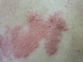 Herpes Zoster, Shingles are caused by a virus. varicella-zoster virus, Royalty Free Stock Photo