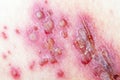 Herpes Zoster (Shingles)