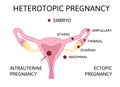 Heterotopic Pregnancy. extra-uterine ectopic pregnancy and intrauterine pregnancy occur simultaneously Royalty Free Stock Photo