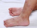 hfmd hand foot mouth virus red blisters on both legs and feet epidemic in sick children Painful red rash