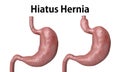 The hiatal hernia is the advancement of part of the stomach towards the esophagus, isolated over white background