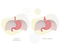 Hiatal Hernia - Hiatus Opening in Diaphragm - Stock Illustration