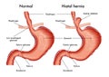 Hiatal hernia medical illustration