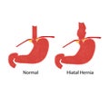 Hiatal hernia and normal anatomy of the stomach and esophagus Royalty Free Stock Photo