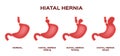 Hiatal hernia / stomach