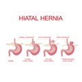 Hiatal hernia. Hiatal hernia and normal anatomy of the stomach