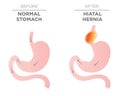 Hiatus Hernia Stomach Image