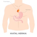 Hiatus Hernia Stomach Image