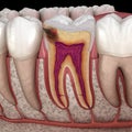 Hidden caries in to molar tooth. Medically accurate 3D illustration Royalty Free Stock Photo