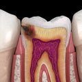 Hidden caries in to molar tooth. Medically accurate 3D illustration Royalty Free Stock Photo