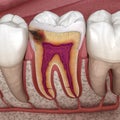 Hidden caries in to molar tooth. Medically accurate 3D illustration Royalty Free Stock Photo