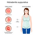 Hidradenitis suppurativa. Affected areas of acne inversa Royalty Free Stock Photo