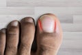 An Elevated View Of Sore Toe Nail On Floor Royalty Free Stock Photo