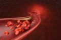 High cholesterol blocked blood cell in artery