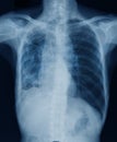 Chest x-ray image