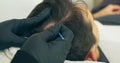 High quality close-up of a man laying on a couch during the esthetician hair treatment. Male tricopigmentation service.