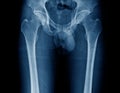 High quality hip and femur bone Royalty Free Stock Photo