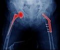 Bilateral hip replacement Royalty Free Stock Photo