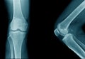 high quality x-ray knee joint of old man Royalty Free Stock Photo